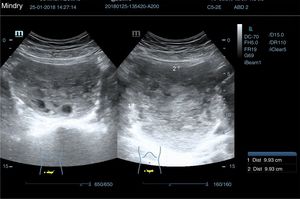 Ecografía abdominal (zona de hipogastrio).