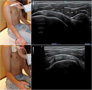 Posición del hombro y de la sonda para el estudio del tendón del subescapular; imágenes normales en sección longitudinal (arriba) y transversal (abajo).