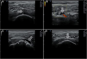 Diferentes hallazgos en ecografía del hombro. A) Aumento de grosor e hipoecogenicidad del tendón de supraespinoso en relación con tendinitis. B) Colección anecoica en la vaina de la porción larga de bíceps con flujo Doppler en relación con tenosinovitis aguda. C) Colección anecoica en la bursa subacromial en relación con bursitis. D) Imagen de adelgazamiento con pérdida de las fibras superficiales (signo de la rueda pinchada) del tendón de supraespinoso en relación con rotura de espesor parcial.