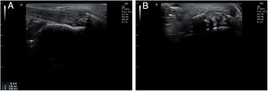 Aumento de grosor, alteración de la disposición normal e hipoecogenicidad de los haces de fibras, calcificaciones, erosiones corticales y pérdida de la definición de los bordes en un caso de entesitis aquílea, vista en plano longitudinal (A) y transversal (B).