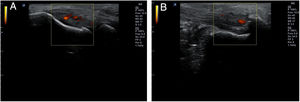 Presencia de neovascularización detectable mediante Doppler de potencia en un caso de epicondilitis (A) y entesitis aquílea (B).