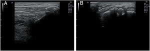Entesofito visualizado en plano longitudinal (A) y transversal (B) en un caso de entesitis cuadricipital.