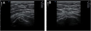 Erosión cortical visualizada en plano longitudinal (A) y transversal (B) en un caso de entesitis trocantérea.