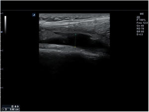 Derrame articular de rodilla: colección anecoica en receso suprarrotuliano.
