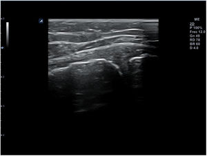 Erosiones corticales en el contexto de enfermedad degenerativa de rodilla.