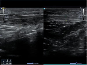 Imagen comparativa de un tendón rotuliano derecho (a la izquierda de la figura) con aumento de grosor e hipoecogenicidad por tendinitis, e izquierdo (a la derecha de la figura) normal.