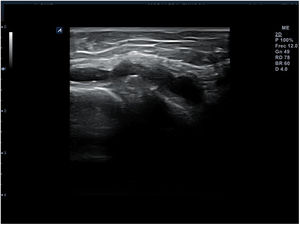 Quiste parameniscal y distensión del ligamento colateral medial de la rodilla.