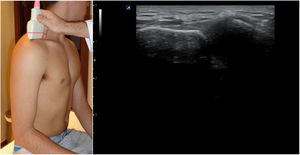 Posición del hombro para el estudio de la articulación acromioclavicular; imagen ecográfica normal.