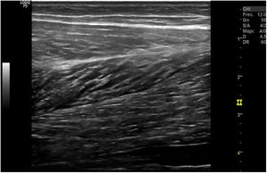 Aspecto ecográfico de un músculo sano en corte longitudinal en «pluma de ave».