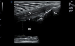 Colección anecoica comprimible con la sonda en un caso de derrame articular en receso superior de rodilla. Da: derrame articular; Rot: rótula; Tc: tendón cuadricipital.