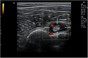 Engrosamiento anecoico (flechas) de la vaina del tendón de la porción larga del bíceps en un caso de tenosinovitis.