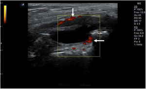 Señal doppler de potencia (flechas) que pone de manifiesto la presencia de neovasos en un proceso inflamatorio agudo sinovial.
