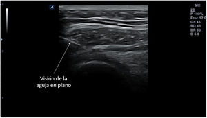 Visión de la aguja en una infiltración de articulación acromioclavicular mediante abordaje posterior «en plano» (flecha).