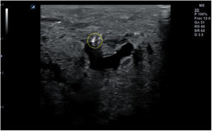 Visión de la aguja en una punción vascular mediante abordaje «fuera de plano» (círculo de puntos).