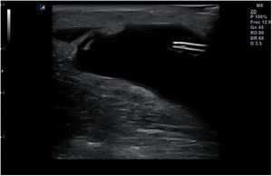 Visión de la aguja en una punción para evacuación de un hematoma superficial traumático.