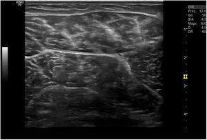 «Aspecto moteado» o reticular ecográfico de un músculo sano en corte transversal.