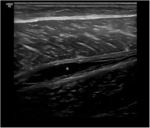 Rotura muscular de grado 1 con área anecoica que afecta solo a la aponeurosis (asterisco).