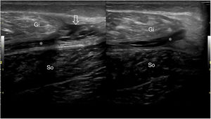 Rotura muscular de grado 2, que afecta a la unión miotendinosa entre el gemelo interno (Gi) y el soleo (So), con líquido interfascial (asterisco) y pequeño hematoma interfibras (flecha), típica tennis leg (pierna tenista).