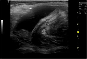 Rotura muscular de grado 3, con disrupción de fibras musculares y gran hematoma.