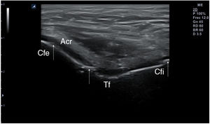 Calcificaciones lineales en el grosor del cartílago de la tróclea femoral (TF) y de los cóndilos femorales externo (Cfe) e interno (Cfi) obtenidas en corte transversal de la rodilla en flexión máxima.