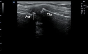 Irregularidad y espiculación cortical (osteofitos)en las epífisis articulares acromial (Acr) y clavicular (Cla) en un caso de artrosis incipiente de la articulación acromioclavicular (flechas).