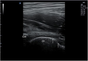 Irregularidad de la cortical (flechas) de la cabeza femoral en un corte longitudinal de la cadera. Cf: cabeza femoral; cót: cótilo.