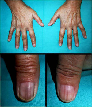 Hiperpigmentación cutánea. Líneas y bandas longitudinales hiperpigmentadas en las uñas de los primeros dedos de ambas manos.