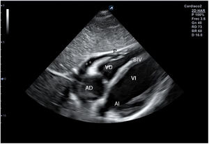 Corte ecográfico de plano subcostal o subxifoideo. VD: ventrículo derecho; AD: aurícula derecha; VI: ventrículo izquierdo; AI: aurícula izquierda; SIV: septo interventricular; P: pericardio; ** derrame pericárdico