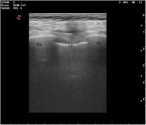 Corte longitudinal de la pared torácica. Imagen ecográfica. Cs: costilla superior; Lp: línea pleural; Ci: costilla inferior.