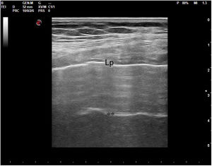Corte oblícuo intercostal de la pared torácica. Imagen ecográfica. Lp: Línea pleural; ** artefacto de reverberación de la línea pleural.