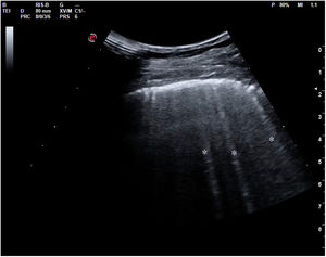 Líneas “B” señaladas por asterisco (*)