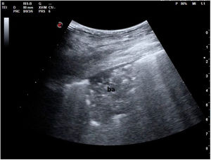 Imagen ecográfica de una condensación pulmonar con broncograma aéreo (ba).