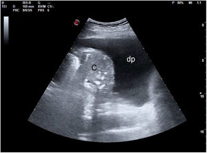 Imagen ecográfica de condensación (c) y derrame pleural (dp).