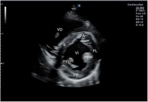 Plano paraesternal de eje corto: corte sobre músculos papilares. VD: ventrículo derecho; VI: ventrículo izquierdo; S: septo; PA: pared anterior; PL: pared lateral; PP: pared posterior; mppm: músculo papilar posteromedial; mpal: músculo papilar anterolateral