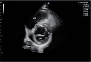 Plano paraesternal de eje corto: corte sobre válvula mitral. VD: ventrículo derecho; S: septo; PA: pared anterior; PL: pared lateral; PP: pared posterior; Vm: válvula mitral