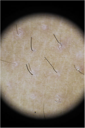 Imagen dermatoscópica. Detalle de los pelos fragmentados.
