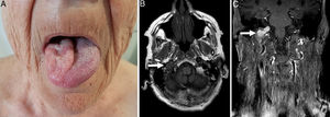 A: Hemiatrophy of the tongue, on the right side, and the inability to completely deviate the tongue toward the left side of the mouth on protrusion. B: T1-weighted MRI demonstrated a 35×20×20mm hypointense tumor occupying the right jugular foramen and extending into the hypoglossal canal. C: The tumor enhanced intensely after gadolinium injection and showed a characteristic salt-and-pepper appearance.