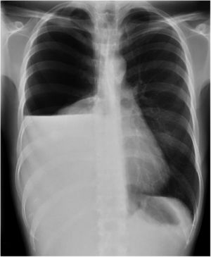 Radiografía de tórax que muestra un gran hidroneumotórax derecho que condiciona un colapso pulmonar completo con mediastino centrado.