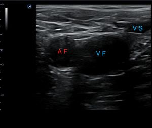 Corte transversal proximal a nivel de la vena femoral común derecha sin compresión de la sonda. AF: arteria femoral; VF: vena femoral; VS: vena safena.