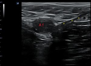 Corte transversal proximal a nivel de la vena femoral común derecha con compresión, en el que se observa la total compresibilidad de la vena femoral y safena interna. AF: arteria femoral; ***: vena femoral y safena colapsadas por la presión del transductor.
