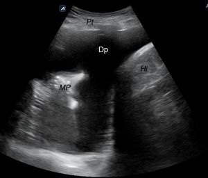 Derrame pleural derecho. Dp: derrame pleural; Hi: hígado; MP; muñón pulmonar; Pt: pared torácica.