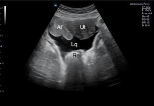 Líquido libre en fondo de saco de Douglas. Ai: asas intestinales; Lq: líquido; Re: recto; Ut: útero.