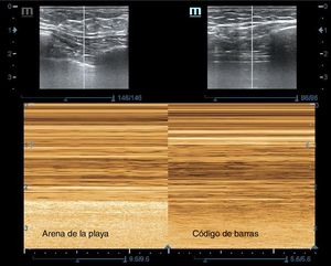 Vista ecográfica del pulmón en modo M: izquierda de la imagen con deslizamiento pleural, signo de la arena de la playa; derecha de la imagen sin deslizamiento pleural, signo del código de barras en un caso de neumotórax traumático.