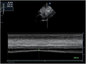 Imagen en modo M sobre la vena cava inferior en ventana subxifoidea, donde se aprecia un calibre espiratorio de 2,15 cm e inspiratorio de 0,95 cm, que corresponde a una colapsabilidad del 55,8% ([2,15-0,95/2,15]*100). DE: diámetro en espiración; DI: diámetro en inspiración.