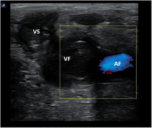 Imagen de ecografía doppler color de la vena femoral izquierda donde se observa contenido ecogénico en el interior de la misma y de la safena interna en un caso de trombosis venosa profunda proximal. AF: arteria femoral; VF: vena femoral; VS: vena safena.