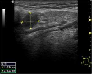 Adenopatía patológica. Linfoma no Hodgkin.