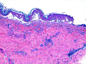 Imagen histológica con múltiples vasos dérmicos trombosados junto con una extensa púrpura y necrosis epidérmica (H&E ×10).