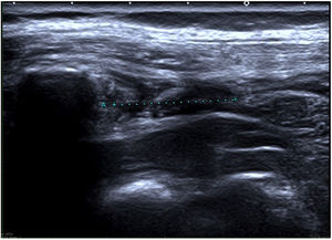 Imagen de ecografía de tórax donde se visualiza, entre los cursores de medición, la solución de continuidad de la pared torácica secundaria a la rotura de fibras de la musculatura intercostal.