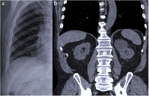 a) Rx de tórax PA en la que se observa un marcado aumento del espacio intercostal entre los arcos posteriores derechos noveno y décimo; b) Reconstrucción coronal de una TC de tórax sin contraste en la que se confirma el ensanchamiento intercostal y se observa la protrusión de un pequeño segmento de pulmón e hígado a través del defecto de pared.