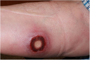 Úlcera indurada de bordes sobreelevados, fondo serohemático y componente fibrinoide central.